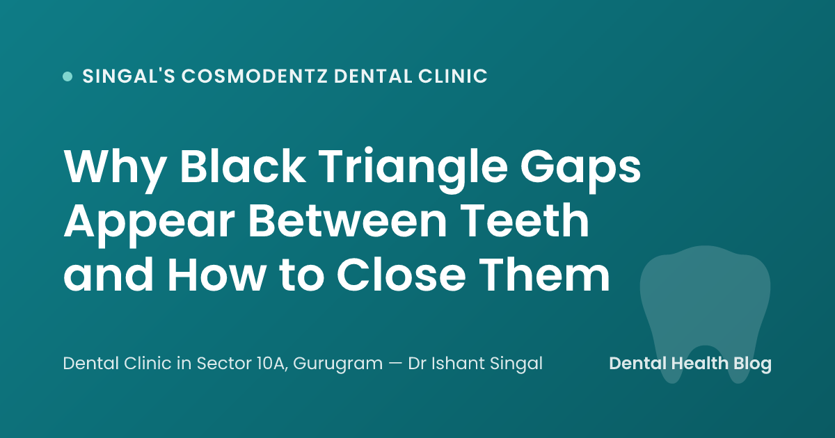 Why Black Triangle Gaps Appear Between Teeth and How to Close Them