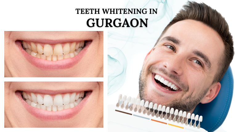Teeth Whitening in Gurgaon