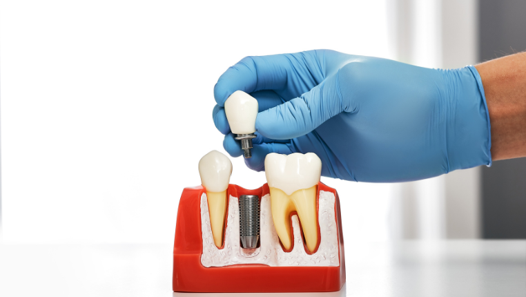 dental implants in Gurgaon