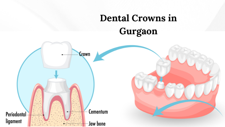dental crowns in Gurgaon