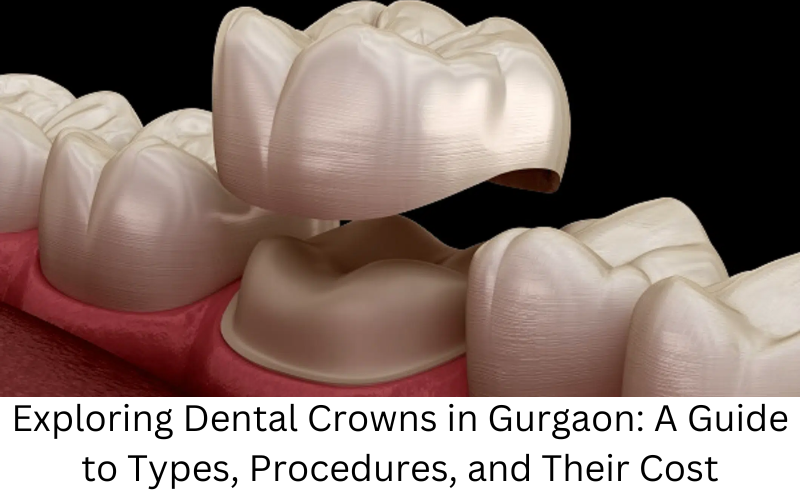 Dental crown in Gurgaon