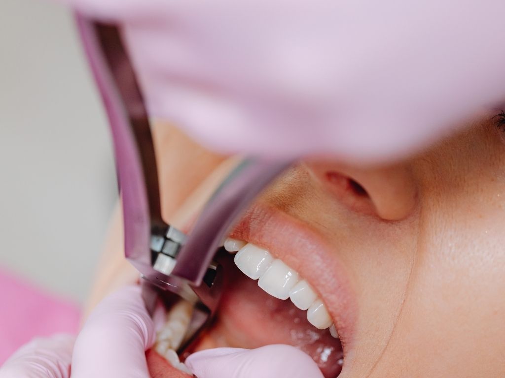 Tooth Extraction in Gurgaon: Comprehensive Care