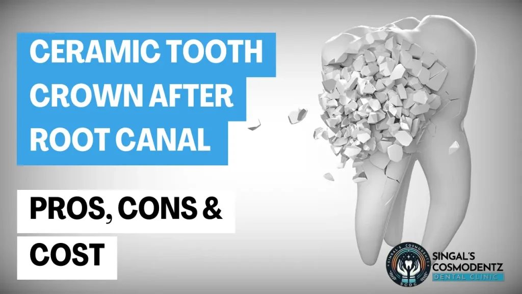 Ceramic tooth crown for root canal – pros, cons and cost explained at Singal’s Cosmodentz Dental Clinic.