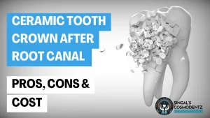 Ceramic tooth crown for root canal – pros, cons and cost explained at Singal’s Cosmodentz Dental Clinic.