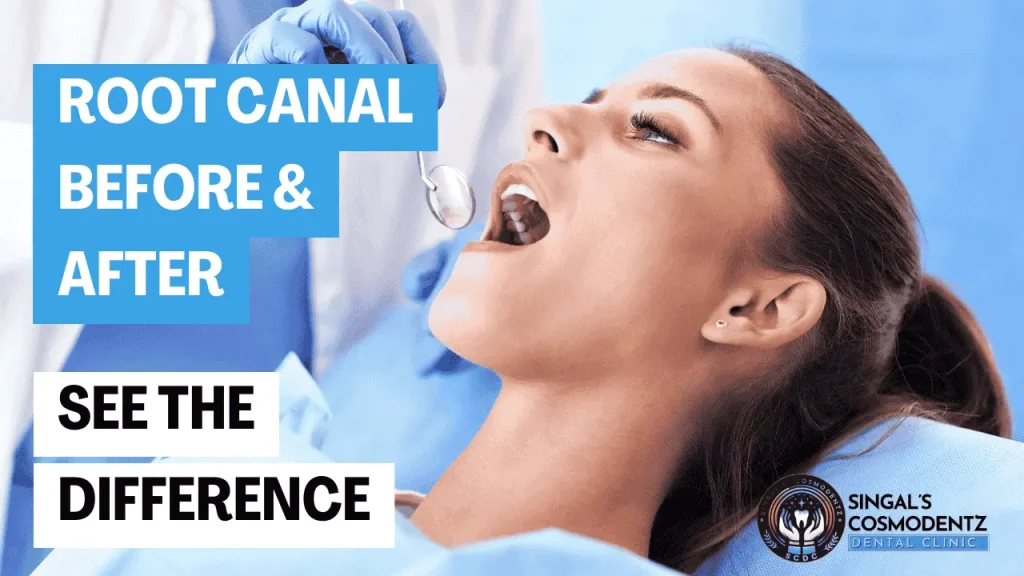Patient undergoing root canal treatment at Singal's Cosmodentz Dental Clinic Gurgaon