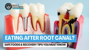 Illustration of teeth showing root canal treatment with safe eating and recovery tips after root canal by Singal’s Cosmodentz Dental Clinic.