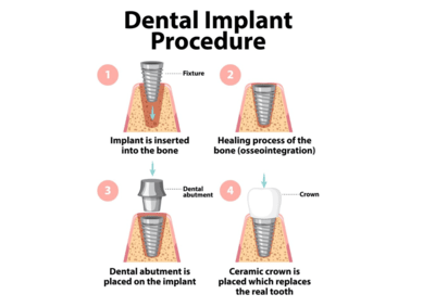 Best Dental Implants in Gurgaon